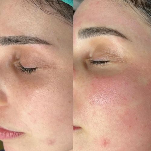 Microneedling